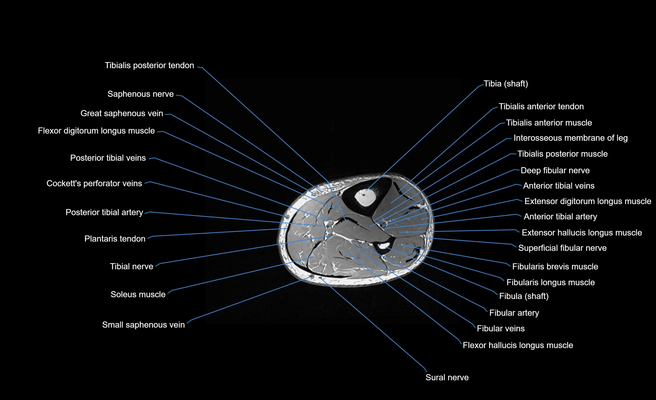 MRI lower leg axial cross sectional anatomy 3T  radiology  image-img-00001-00063.webp